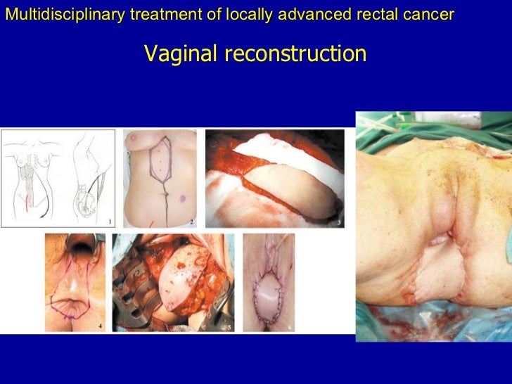 vagina reconstruction pictures Dick hoover wrestling tournament